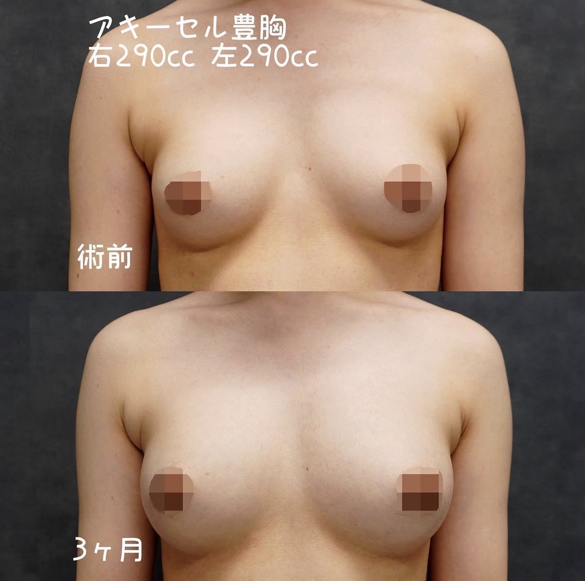 アキーセル脂肪注入豊胸 正面の術前と3か月後