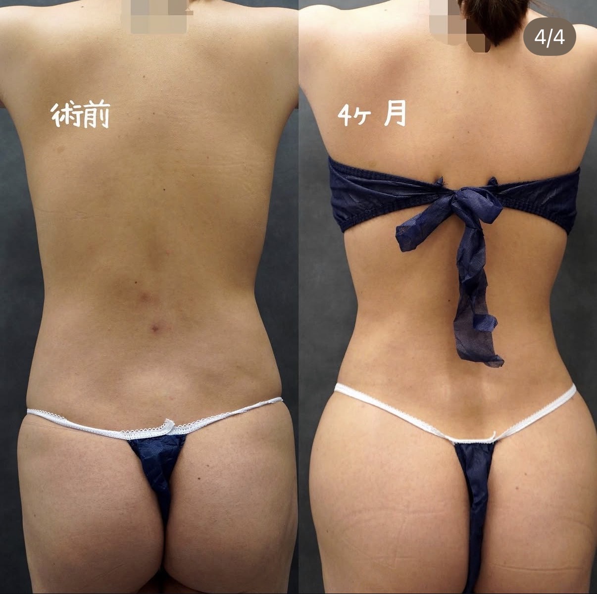 上腹部・下腹部・ウエスト・腰のアキーセル脂肪吸引 背面の術前と術後4か月