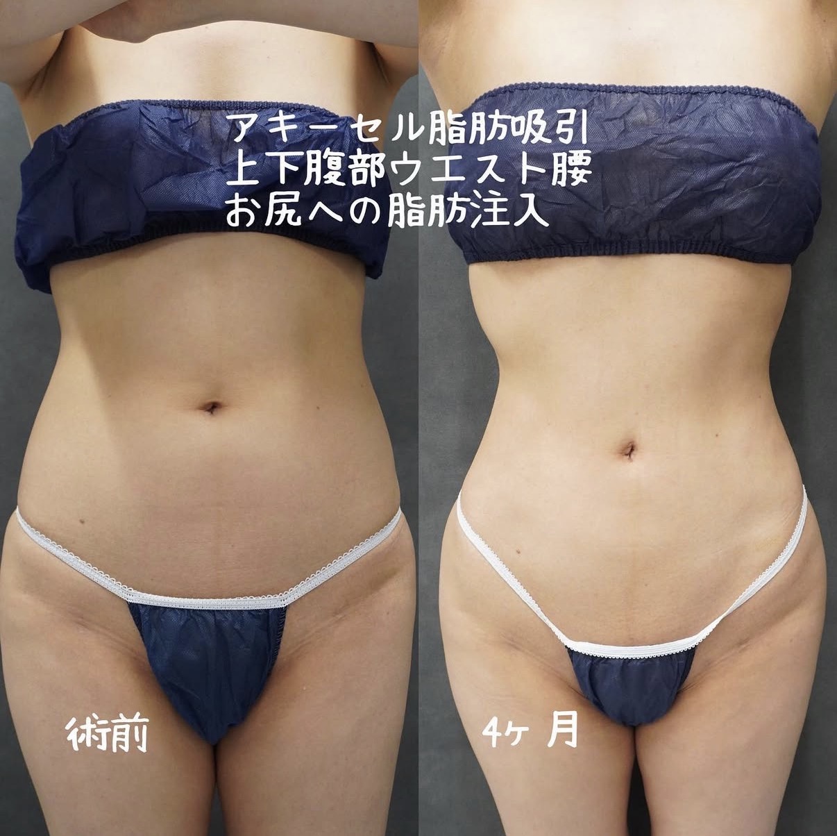 上腹部・下腹部・ウエスト・腰のアキーセル脂肪吸引 正面の術前と術後4か月