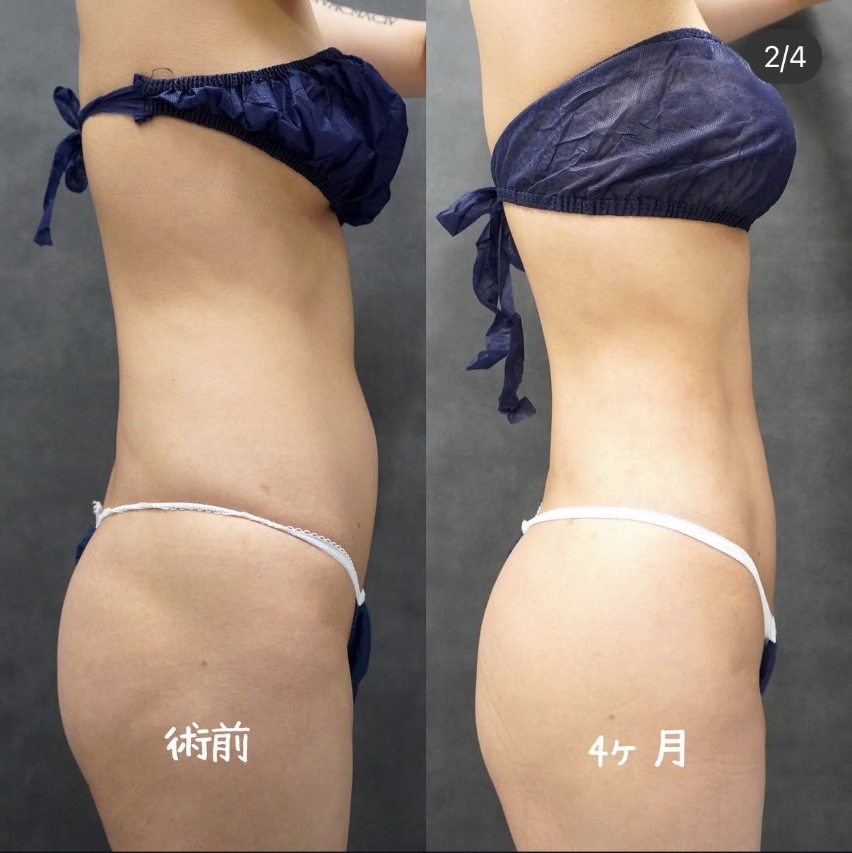 上腹部・下腹部・ウエスト・腰のアキーセル脂肪吸引 側面の術前と術後4か月