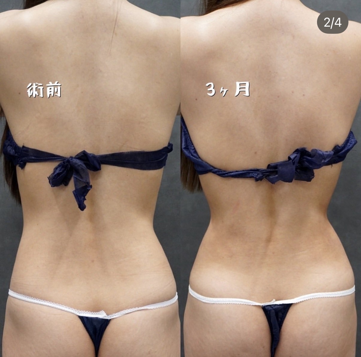 下腹部・ウエスト・腰のベイザー脂肪吸引 背面の術前と術後3か月