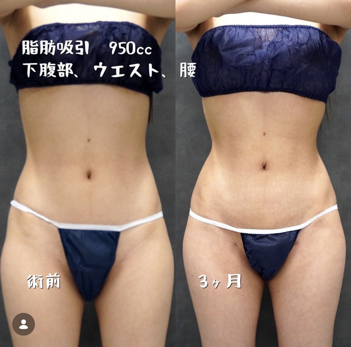 下腹部・ウエスト・腰のベイザー脂肪吸引 正面の術前と術後3か月