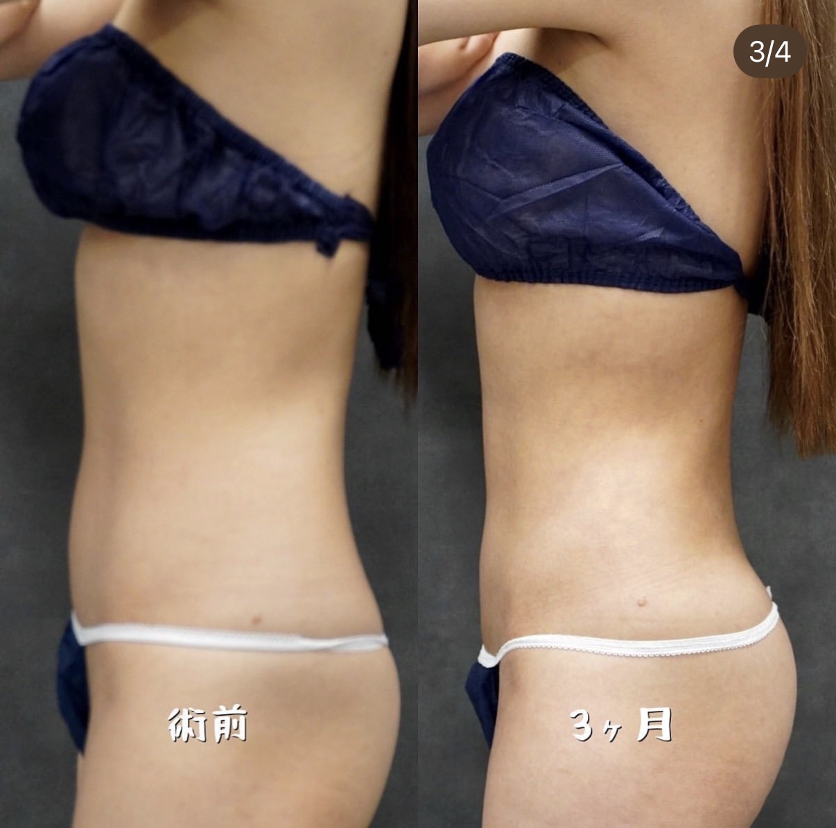 下腹部・ウエスト・腰のベイザー脂肪吸引 側面の術前と術後3か月