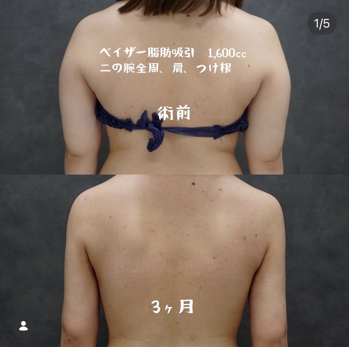 二の腕全周・肩・付け根のベイザー脂肪吸引 背面の術前と術後3か月