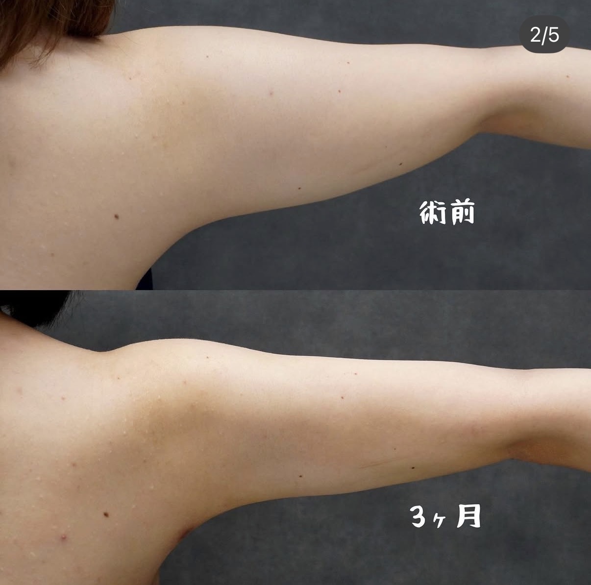 二の腕全周・肩・付け根のベイザー脂肪吸引 腕を上げた状態の術前と術後3か月