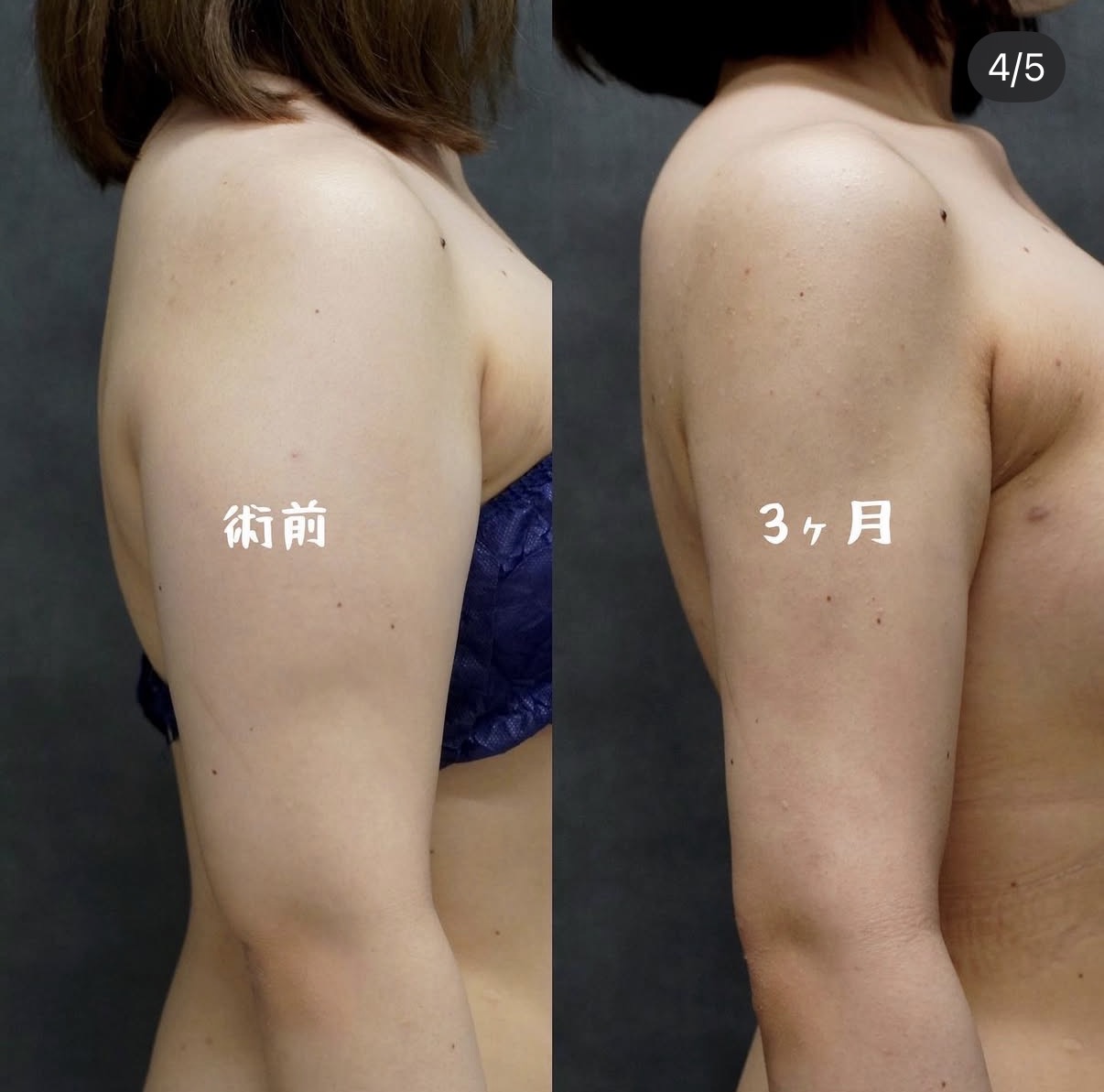 二の腕全周・肩・付け根のベイザー脂肪吸引 側面の術前と術後3か月