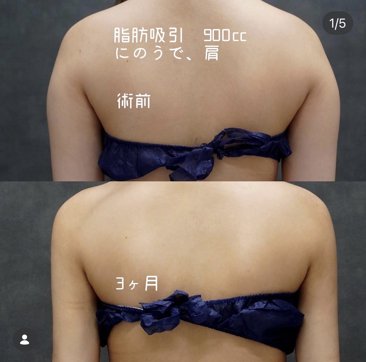 二の腕・肩のベイザー脂肪吸引 背面の術前と術後3か月