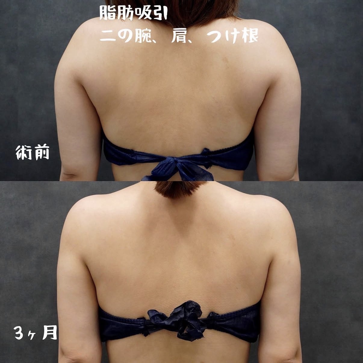 二の腕・肩・付け根のベイザー脂肪吸引 背面の術前と術後3か月