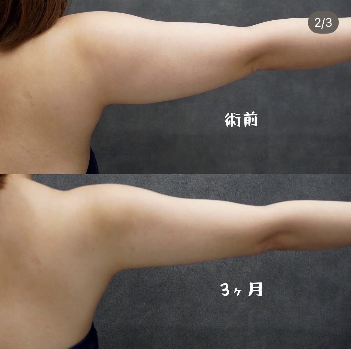 二の腕・肩・付け根のベイザー脂肪吸引 左側の術前と術後3か月
