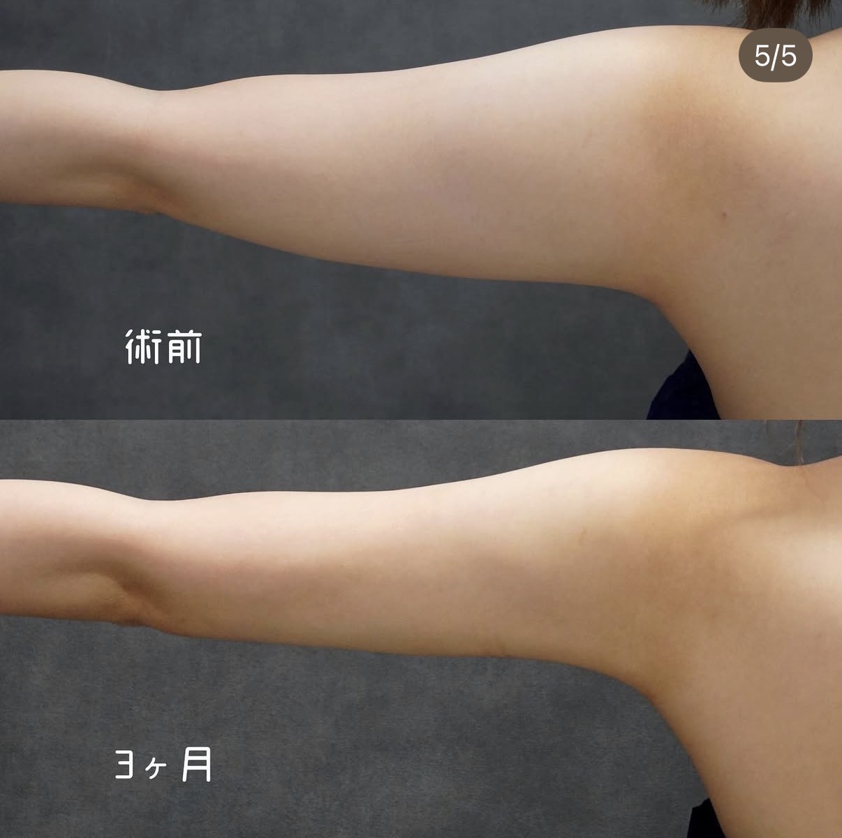 二の腕・肩・付け根のベイザー脂肪吸引 右側の術前と術後3か月
