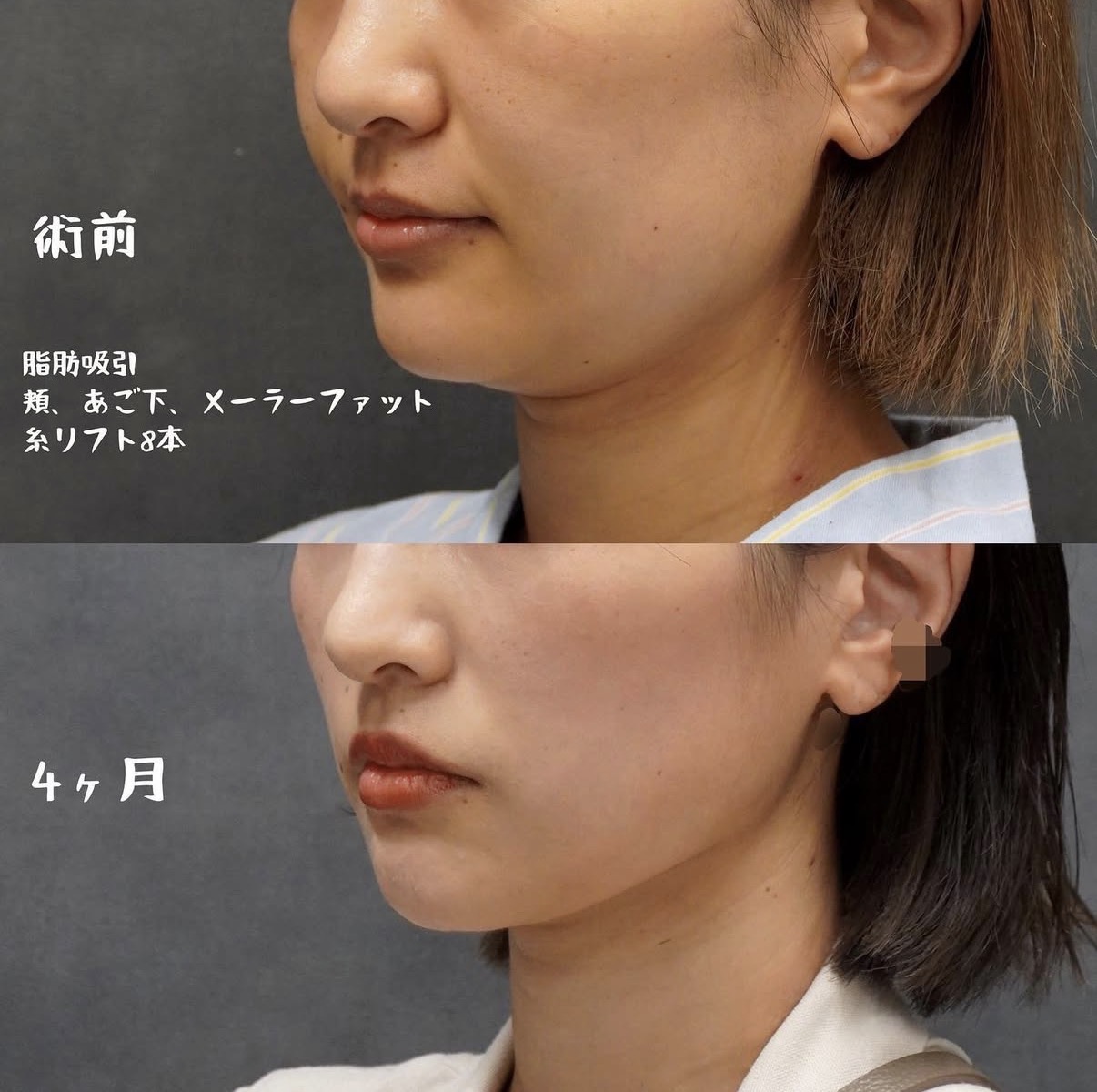 頬・顎下・メーラーファット脂肪吸引と糸リフト8本の斜め方向 術前と術後4か月