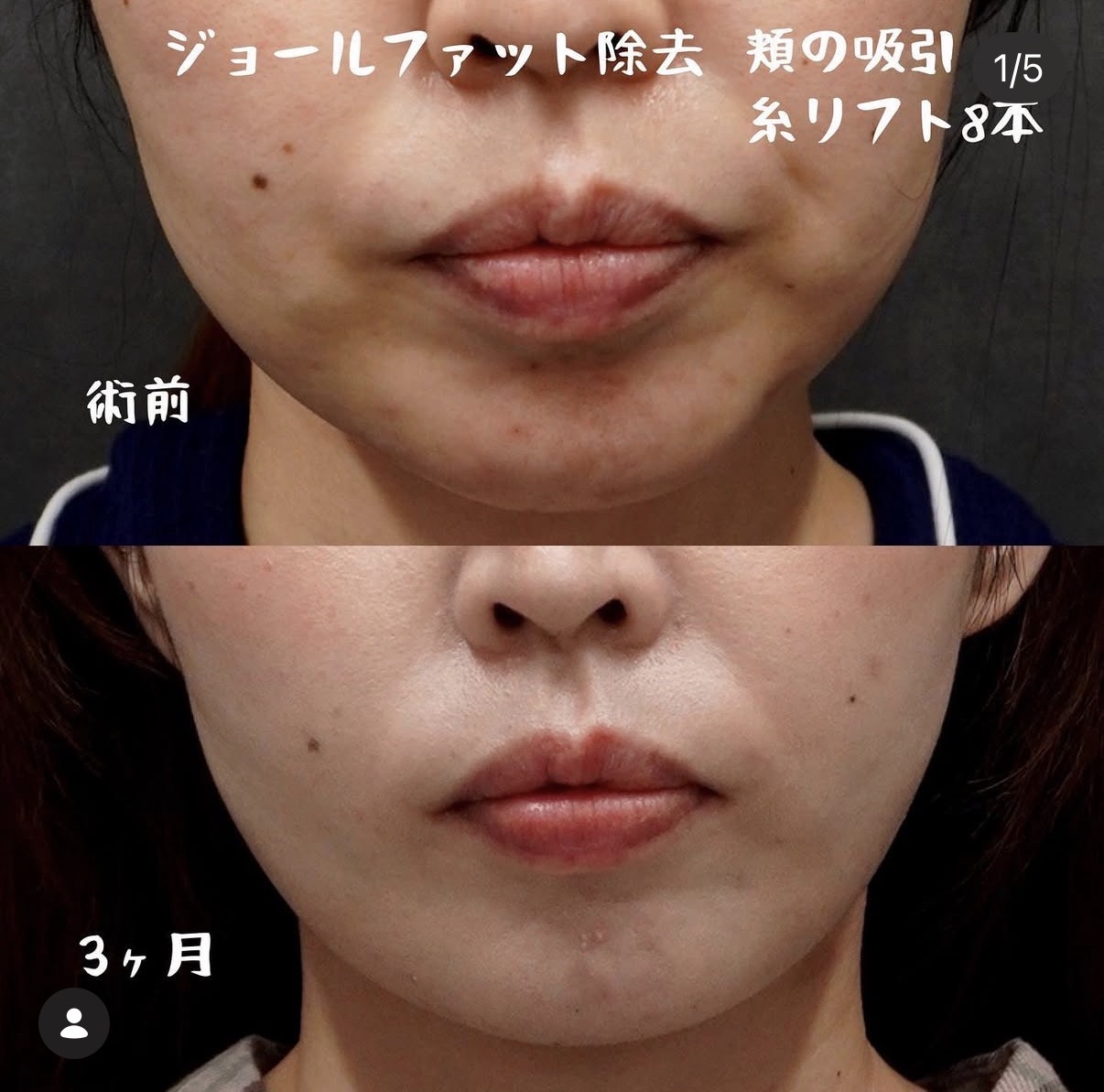 頬脂肪吸引・ジョールファット除去と糸リフト8本の正面 術前と術後3か月