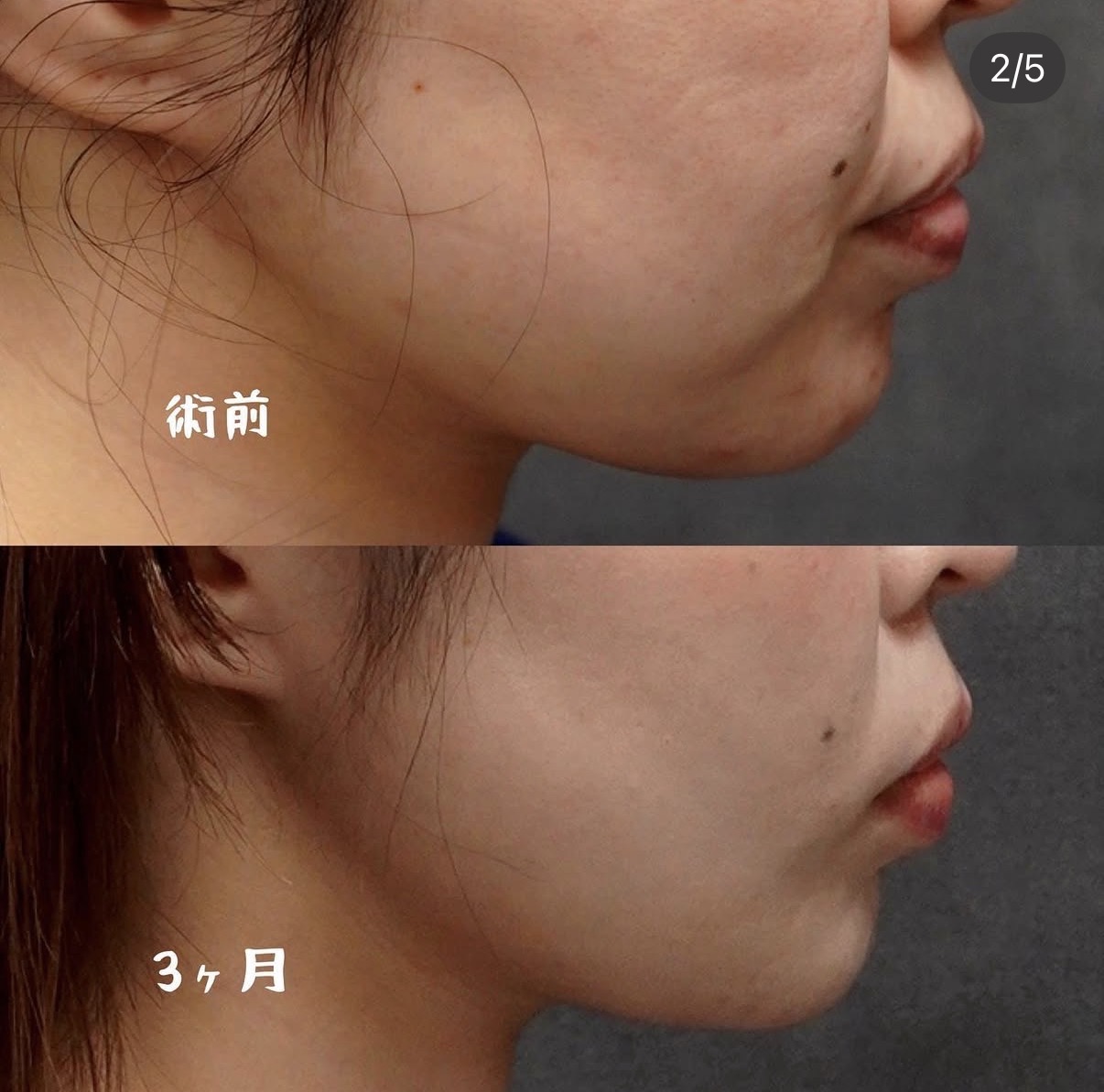 頬脂肪吸引・ジョールファット除去と糸リフト8本の横顔 術前と術後3か月