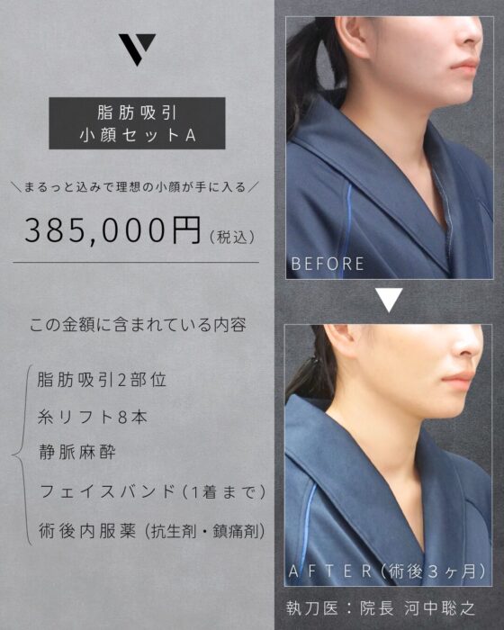 【大阪院】 脂肪吸引価格(小顔セット)
