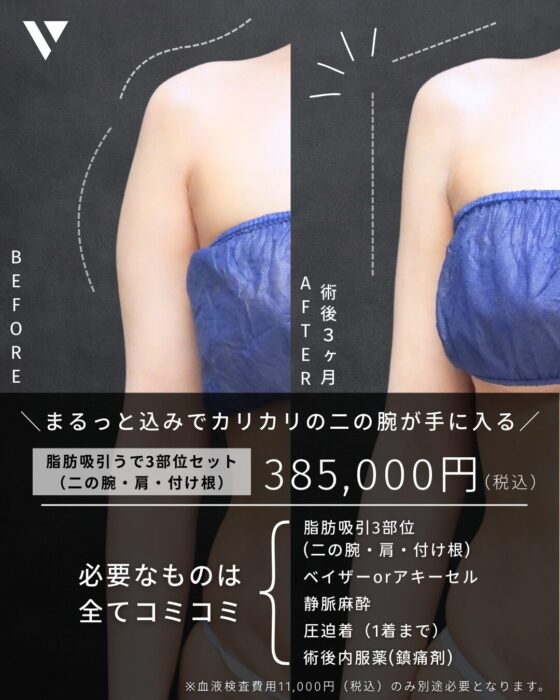 【大阪】西村Dr 1月症例モニター(脂肪吸引・腕)