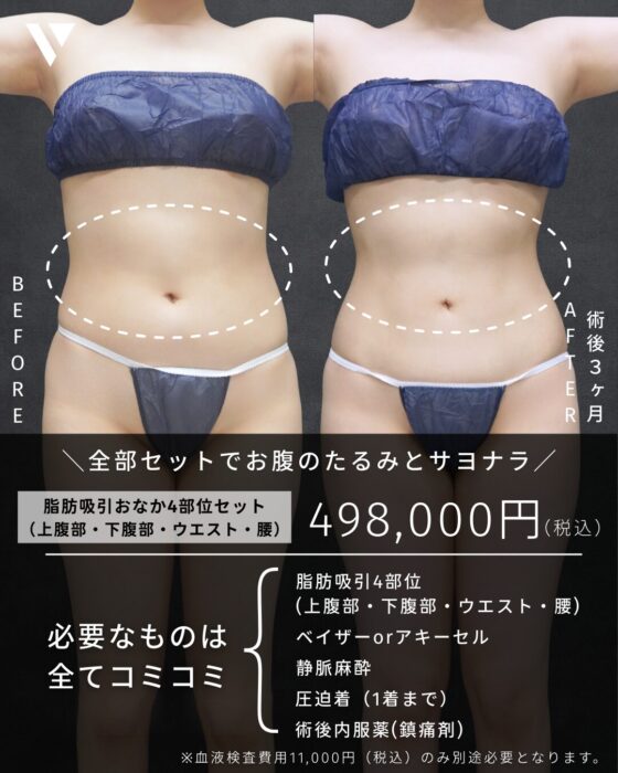 【大阪】西村Dr 1月症例モニター(脂肪吸引・お腹)