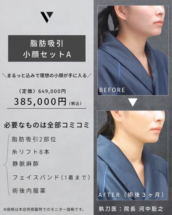 【大阪】河中Dr 4・5月症例モニター（小顔 脂肪吸引）