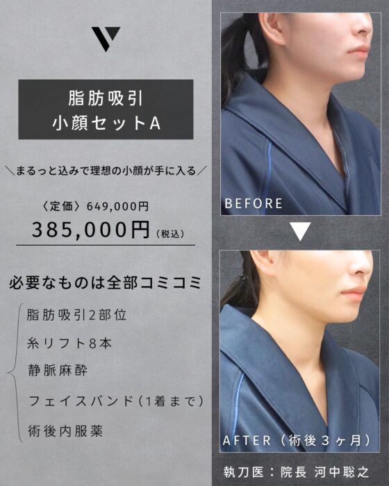 【大阪】河中Dr 3月症例モニター（小顔 脂肪吸引）