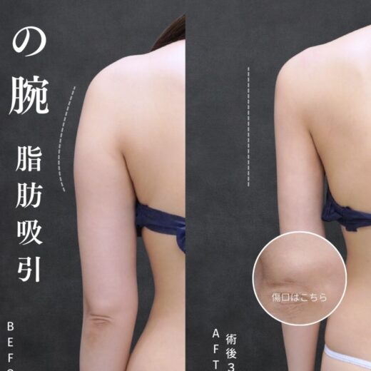 二の腕ベイザー脂肪吸引とは?ダイエットでは落ちない二の腕を理想のラインへ