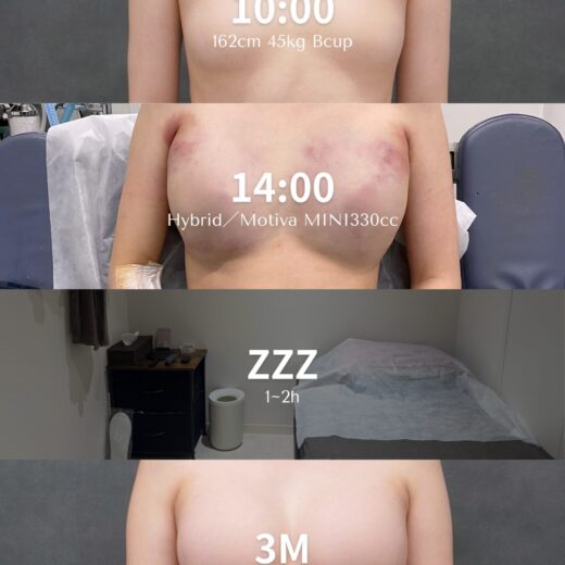 ⏰ 豊胸はどう変化していくの?