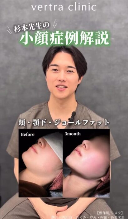 顔の脂肪吸引症例解説