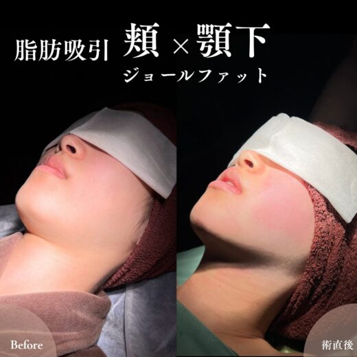 顔の脂肪吸引でどこまで小さくなる?効果が出やすい人の特徴