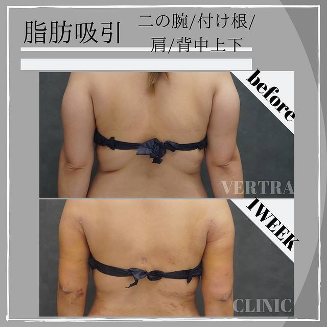 二の腕・肩の脂肪吸引施術写真