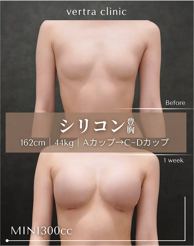 シリコン豊胸B-02