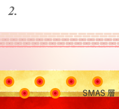 SMAS層を引き締め、脂肪層などを熱凝固させます